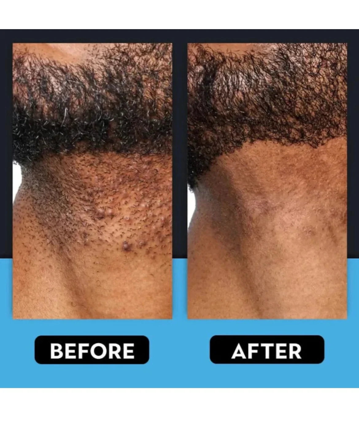 Razor Bump & Ingrown Hair Treatment