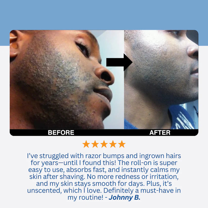 Razor Bump & Ingrown Hair Treatment
